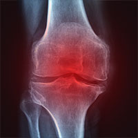 x-ray of a knee joint with a red highlight to indicate pain